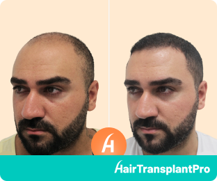 Hair Transplant Regrow Hair