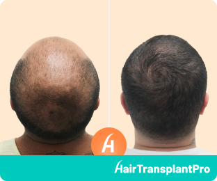 Hair Transplant Best Solution