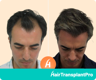 Hair Transplant Mexico Before and After