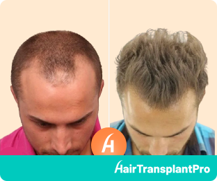 Hair Transplant Greece before and after