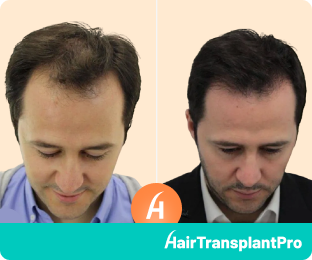 Hair Transplant UK Before and After