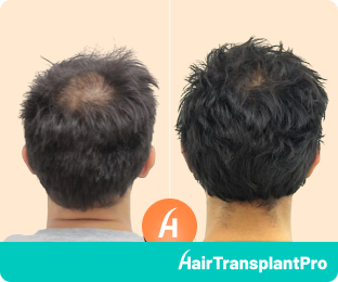 Best Hair Transplant Before and After
