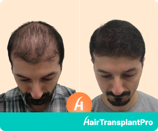 Great Hair Transplant Before and After