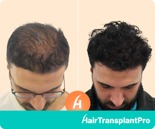 Best Hair Transplant in Turkey