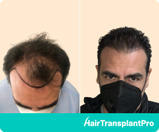 Fue Hair Transplant Before and After