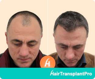Before and After Fue Hair Transplant