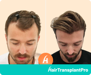 Hair Transplant Results After 12 months