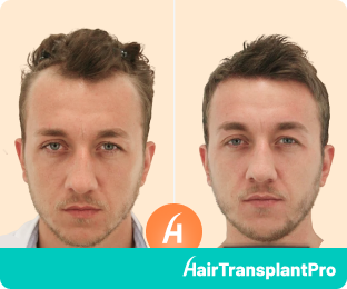 Hair Transplant Results after 6 months