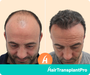 Hair Transplant Results after 18 months